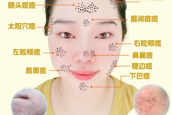 长痘风水学