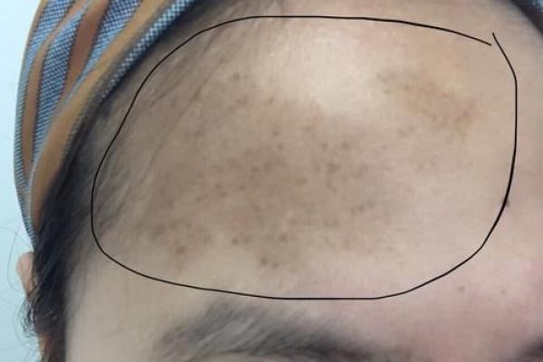 额头上的胎记算命