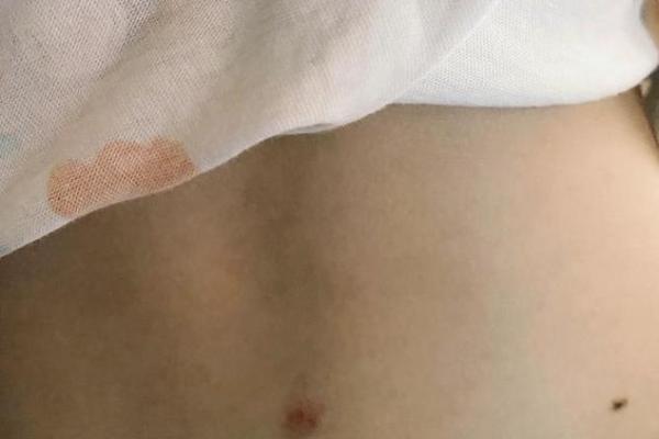 胎记算命：最好胎记长什么部位