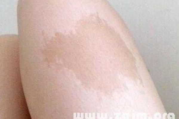 腰部上的胎记如何算命分析？
