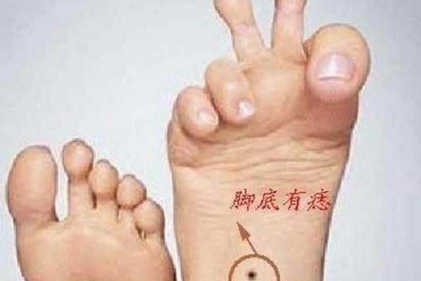 痣相风水脚底有痣的人命运好不好